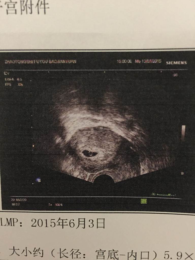 这样的孕囊正常吗?