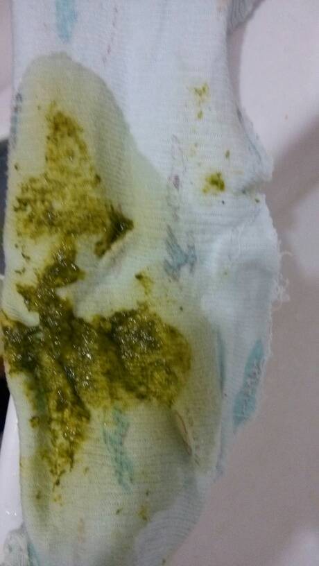 宝宝拉绿便便怎么回事啊,都好几天了,而且一天得八九次