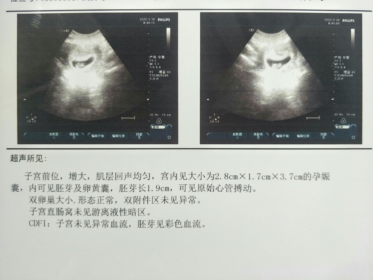 8周男孩胎囊图片图片