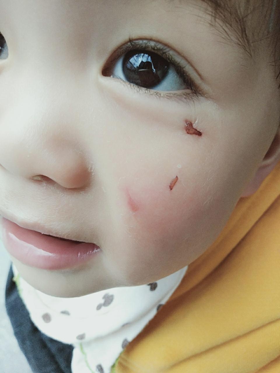 儿童脸上冻疮疤痕图片图片