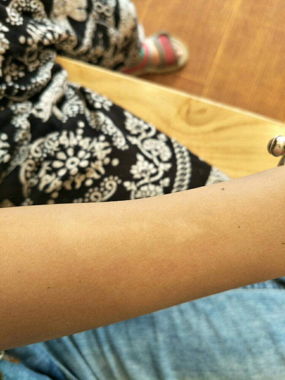 宝宝胳膊上有汗斑怎么办?