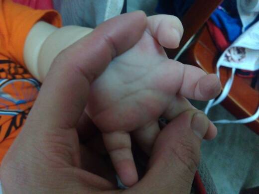 宝宝最近手掌发红但体温正常,谁知道是什么情况?帮忙解答一下 谢谢!