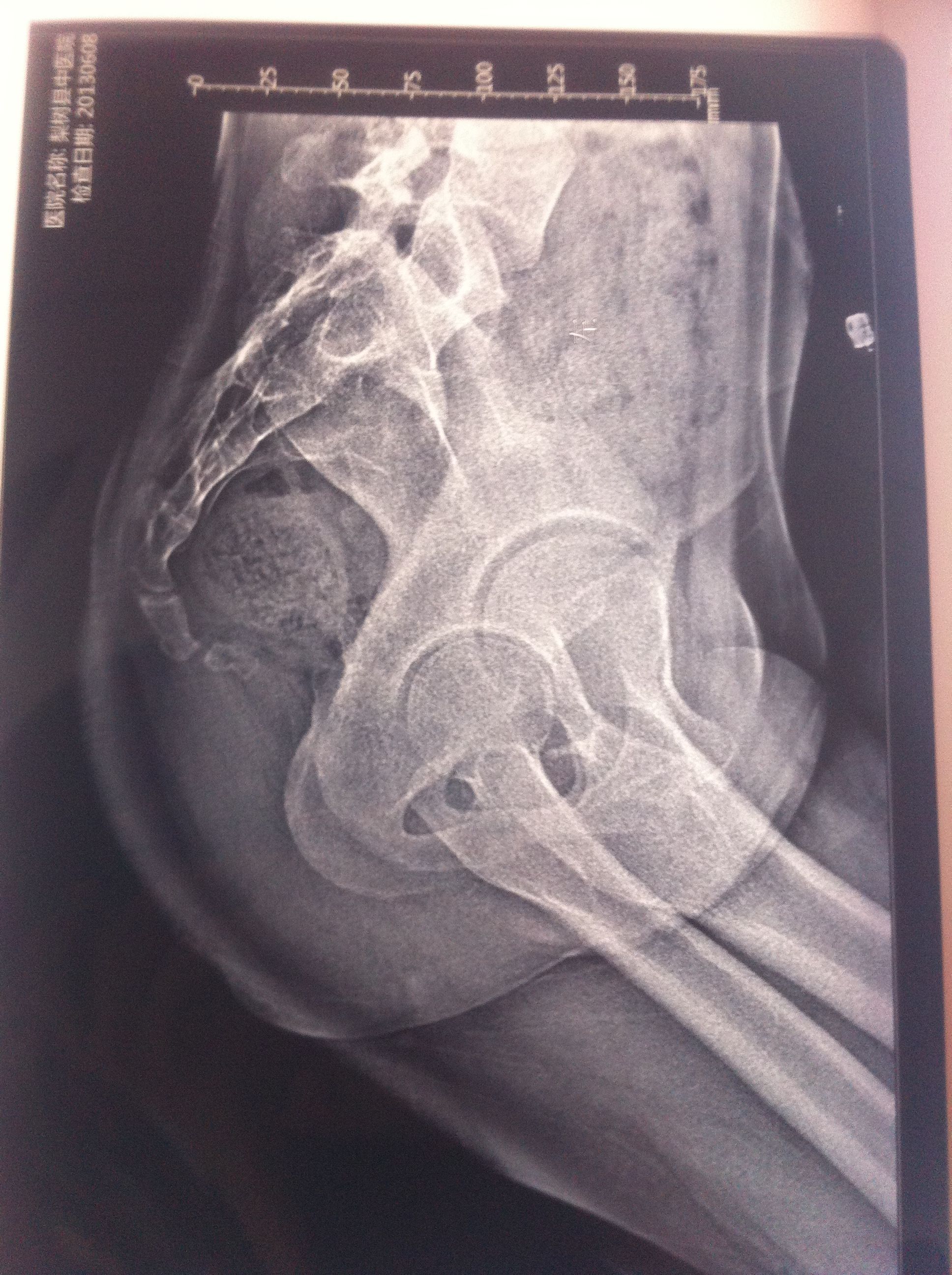 骶骨5椎体骨折图片图片