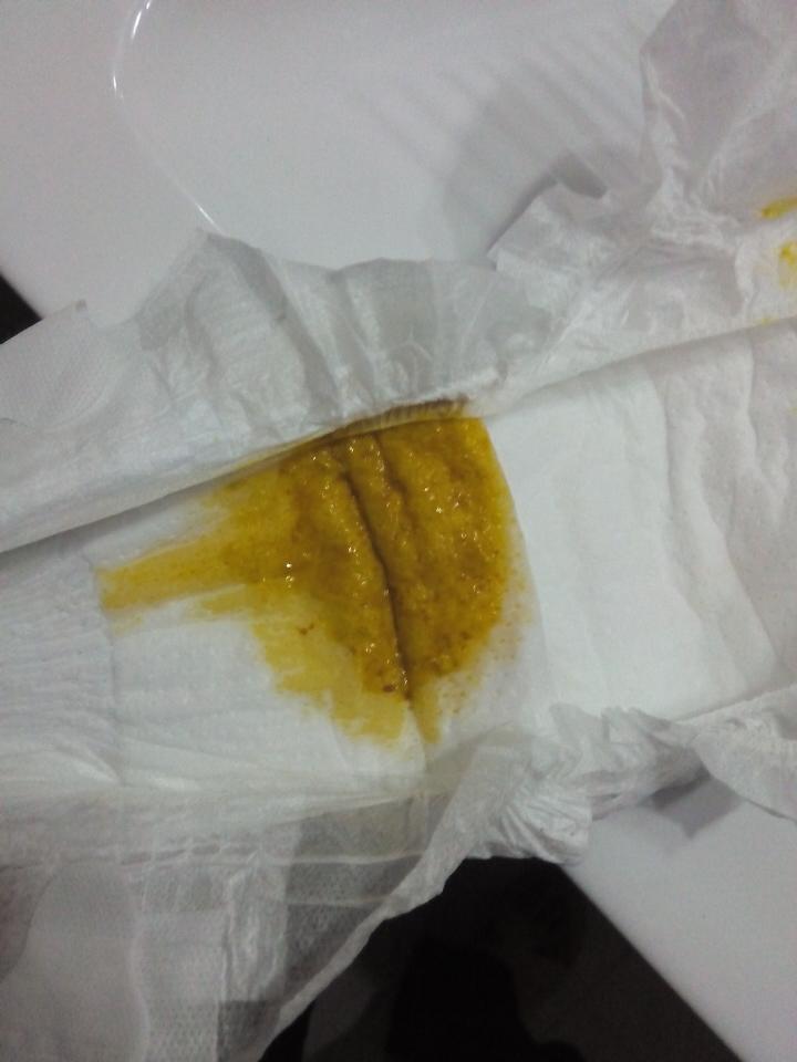 宝宝40天,全母乳喂养,大便性状如图,请问有问题吗?