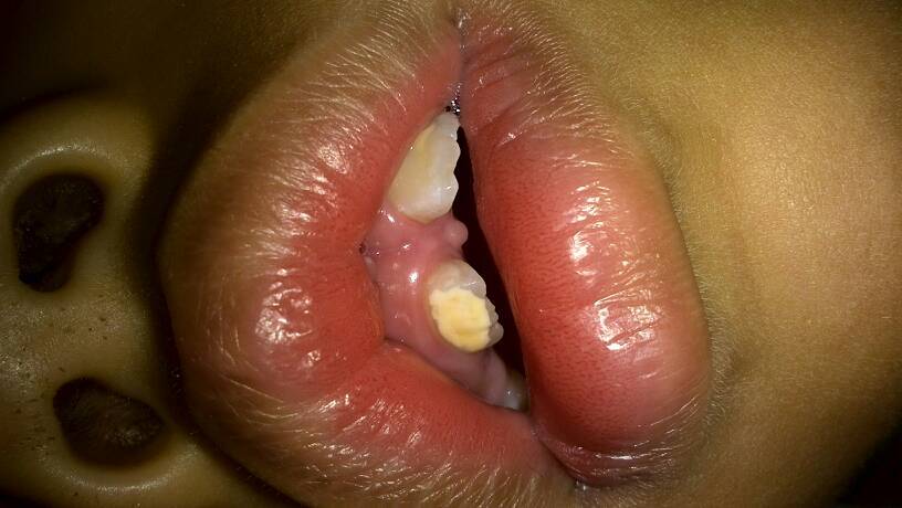 求解答 六岁小孩新长的牙出现很大块不正常的白(如图),请问医生是怎么