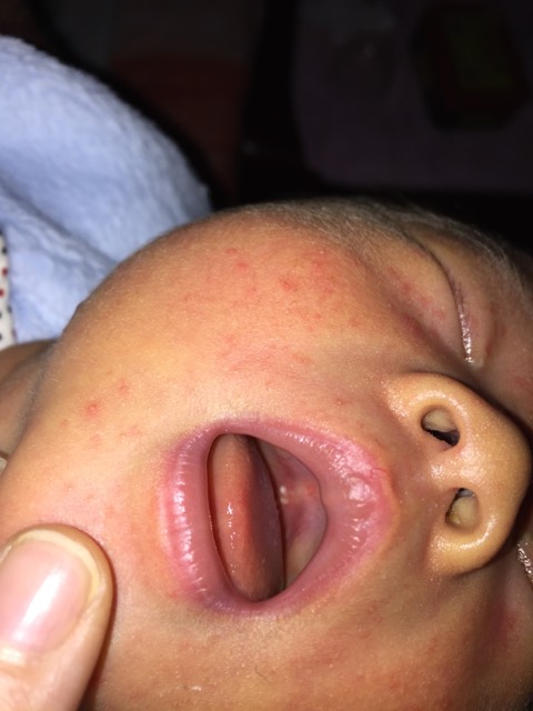 婴儿鹅口疮的症状图片图片