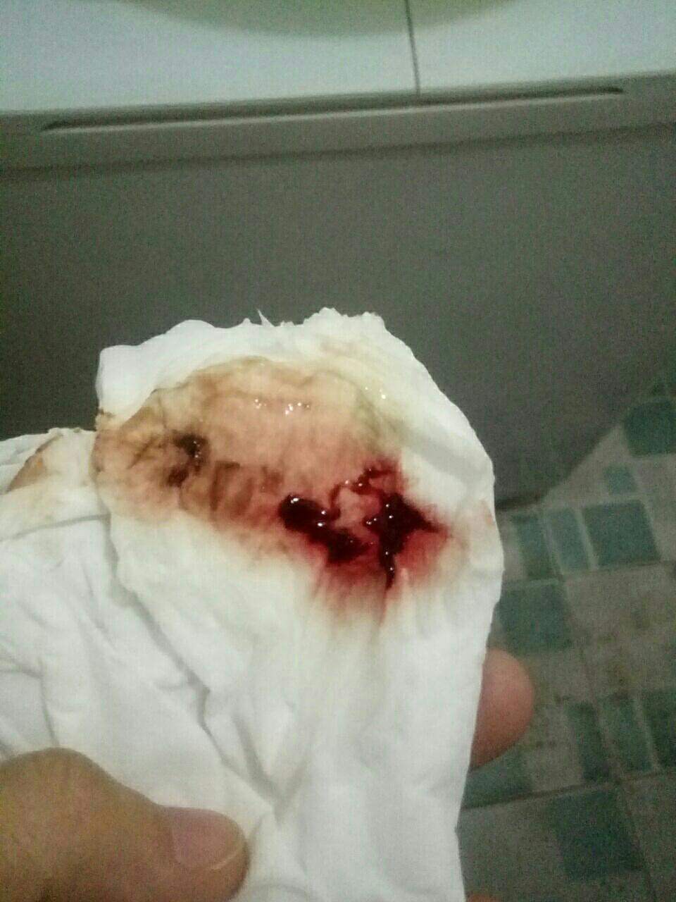 现在都睡不着了!偶尔会有一点胀痛感,要不要现在就去医院等着呀!