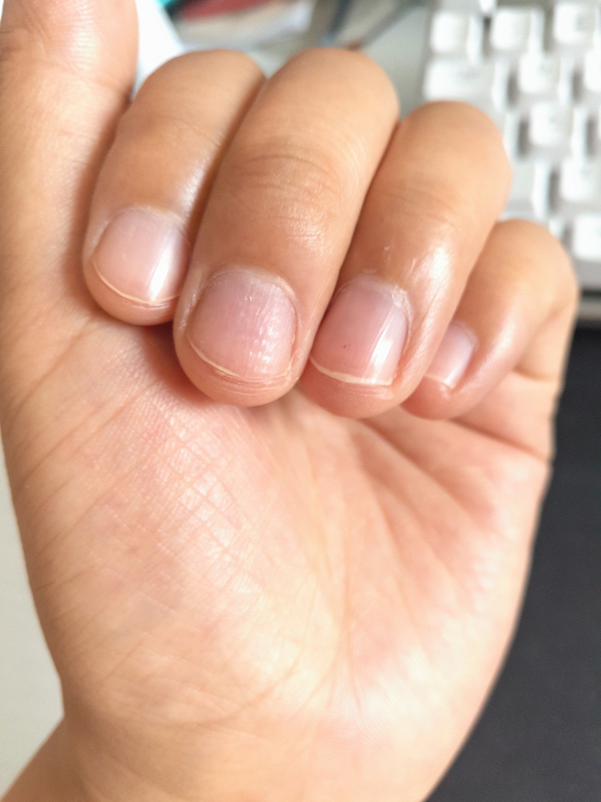 指甲有竖纹和小坑,前两年都没有的 生了小孩之后指甲上就有很多小坑了