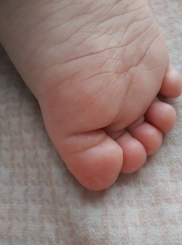 一岁宝宝,手足口病好了几天后,手脚出现这种白色疱,不痛不痒的