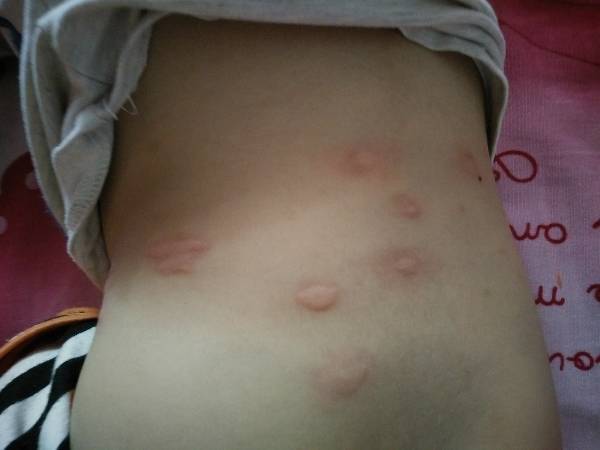 两岁男宝身上起红疙瘩,很痒,没有其他症状,腰部多,其他部位也有就