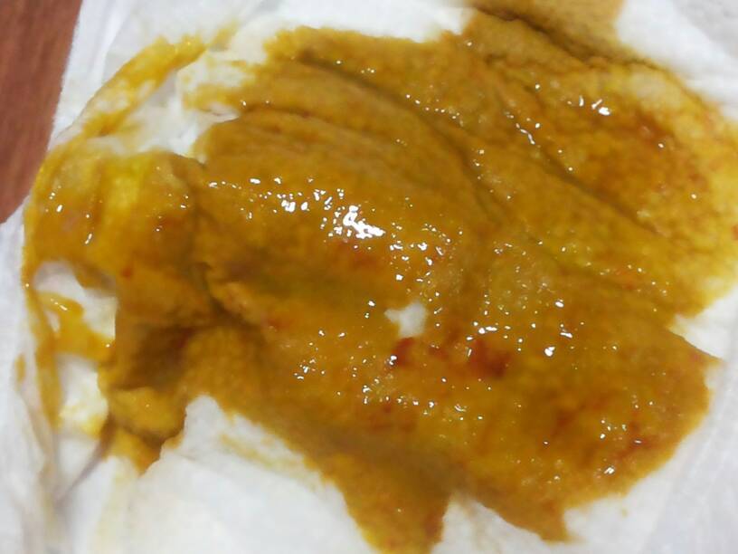 (有图慎入)5个月宝宝拉的粑粑,带点血,有懂的妈妈吗?