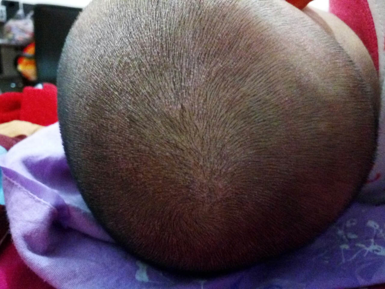 婴儿头部湿疹图片