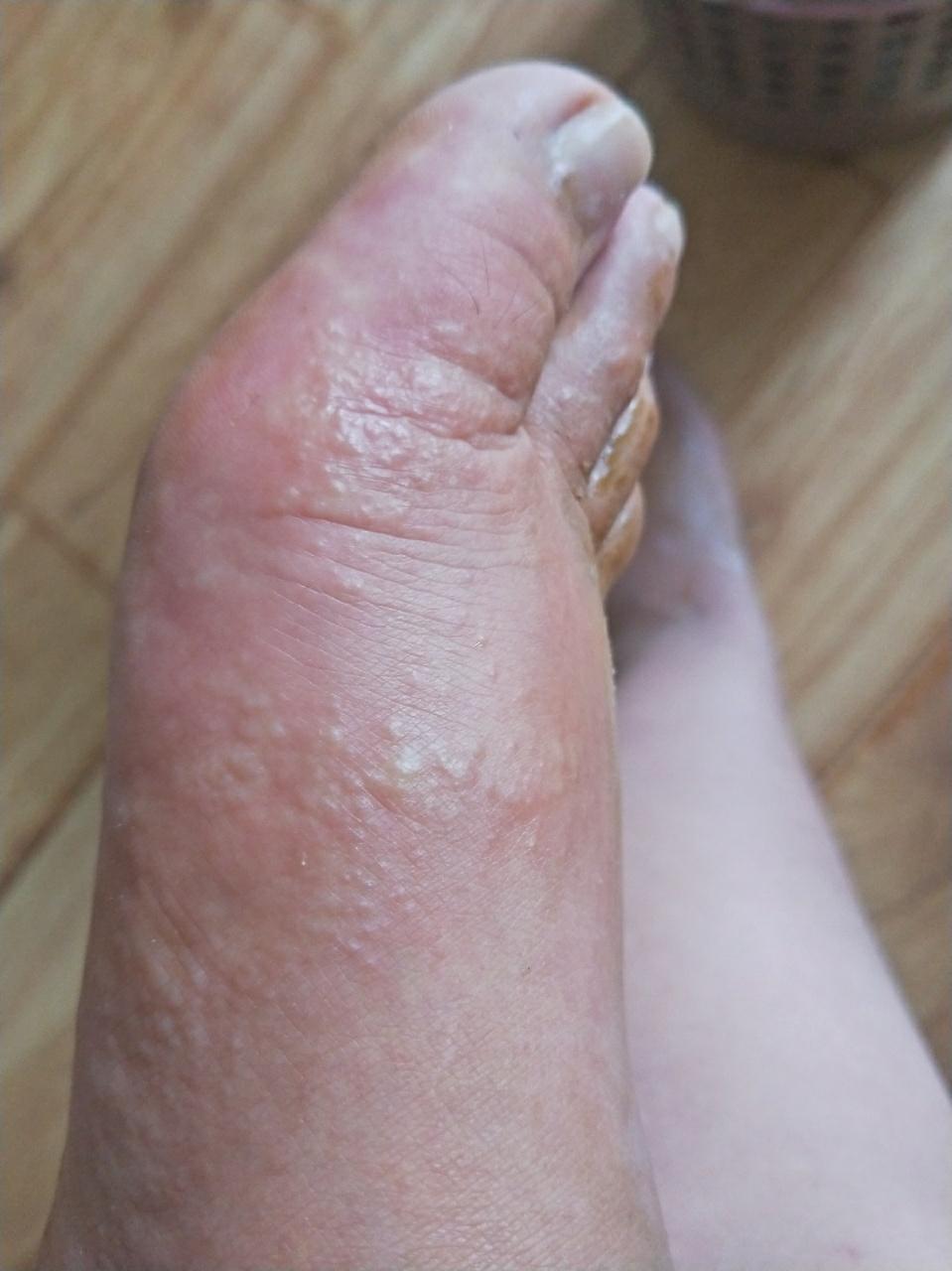 脚上湿疹很痒怎么办图片
