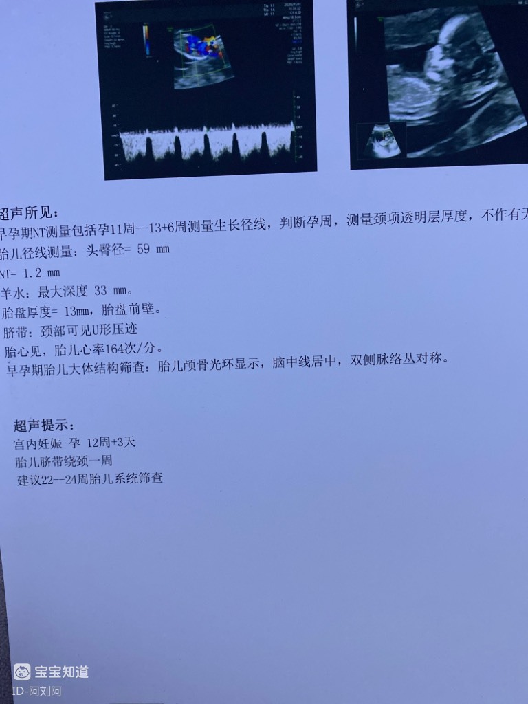 12周做nt发现脐带绕颈一周