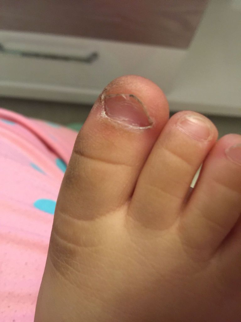 宝宝的脚指甲长这样,是缺什么吗?