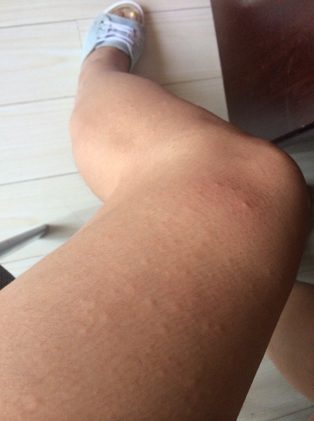 早上出门后身上就这样了,奇痒无比!请问怎么回事?