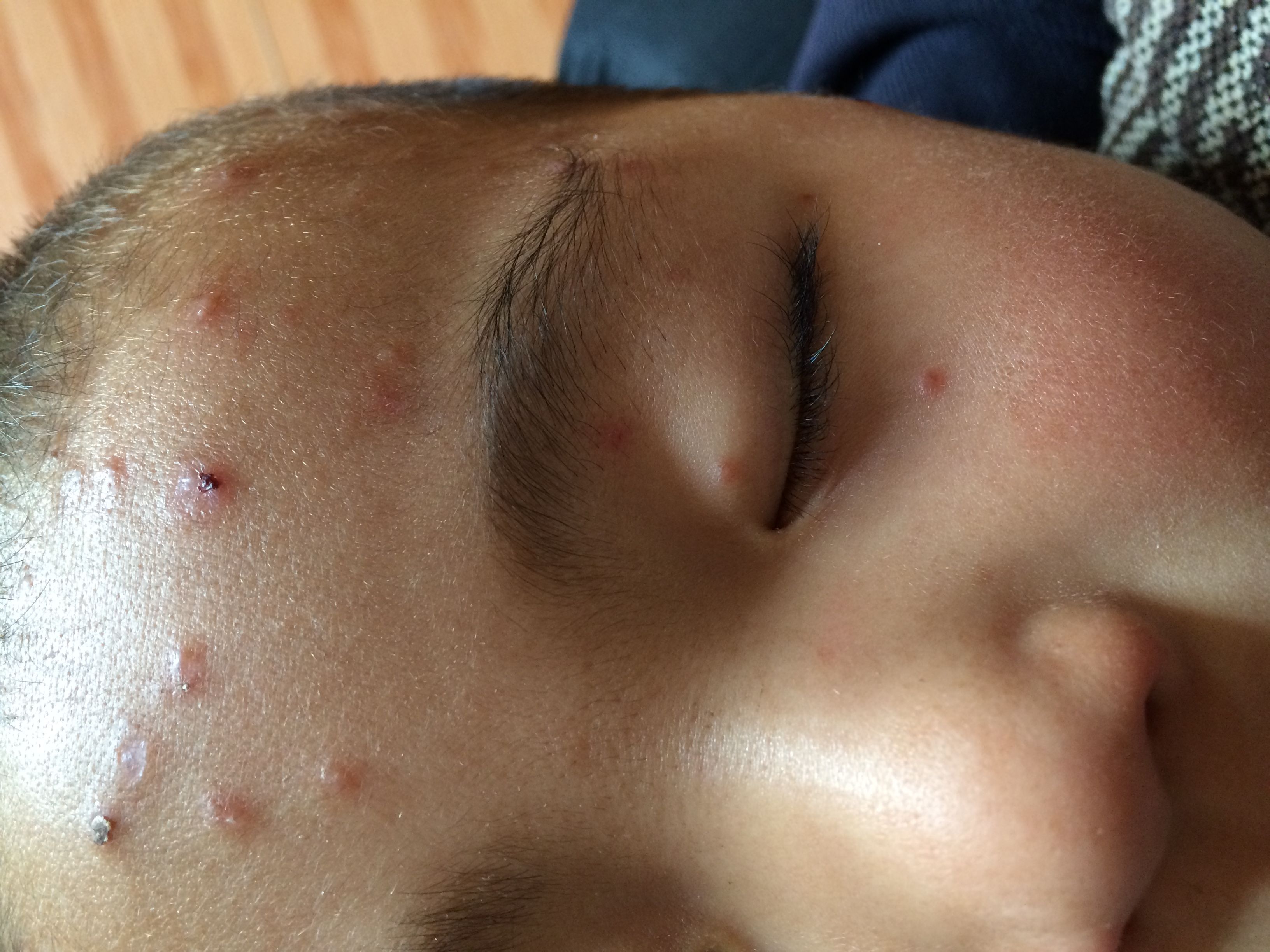 帮忙确诊宝宝是什么皮肤病