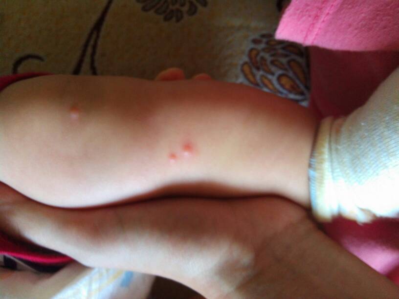 宝宝三个半月腿上突然冒出来了几颗红色的痘痘,请问这是什么呀?