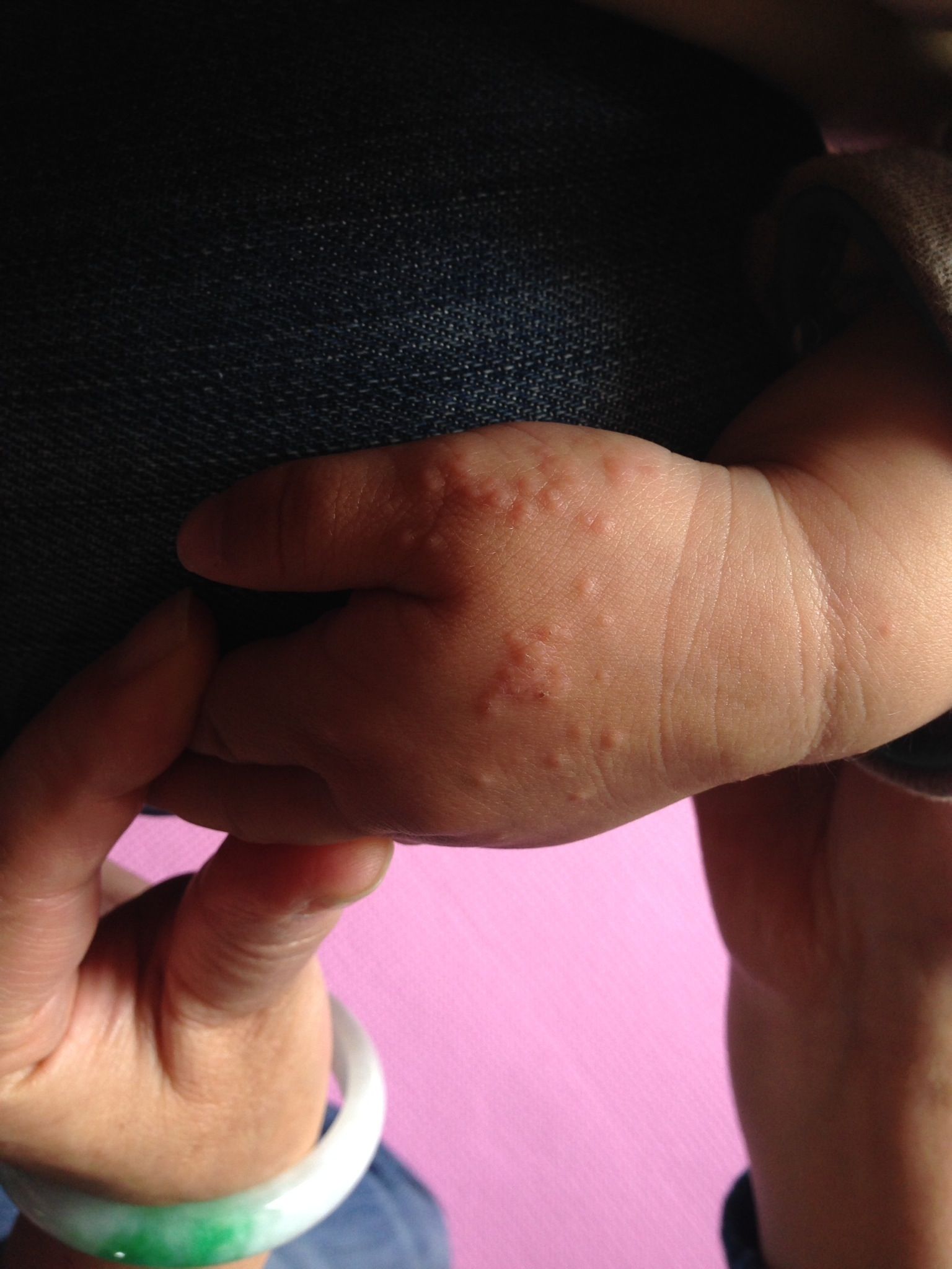 儿童过敏性疱疹图片图片