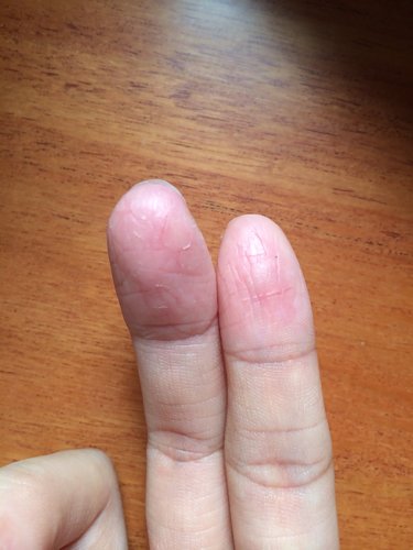 请问这手指长期开裂,每天都涂药膏,各种药膏,就是不见好!