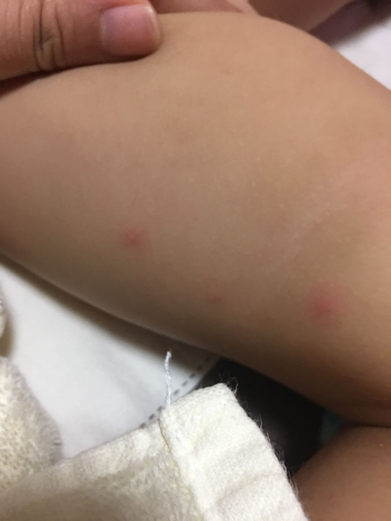 洗完澡发现宝宝大腿内侧出现红斑点 是湿疹吗?