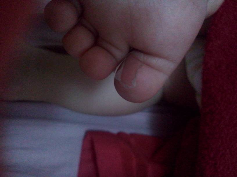 宝宝九个月了,这两天大母脚指头脱皮了怎么回事?