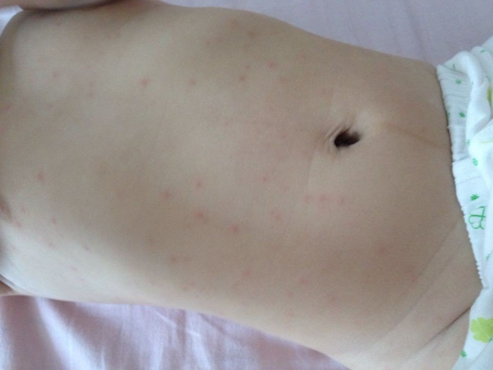 6个多月的宝宝身上出小红点点,急求助,在线等