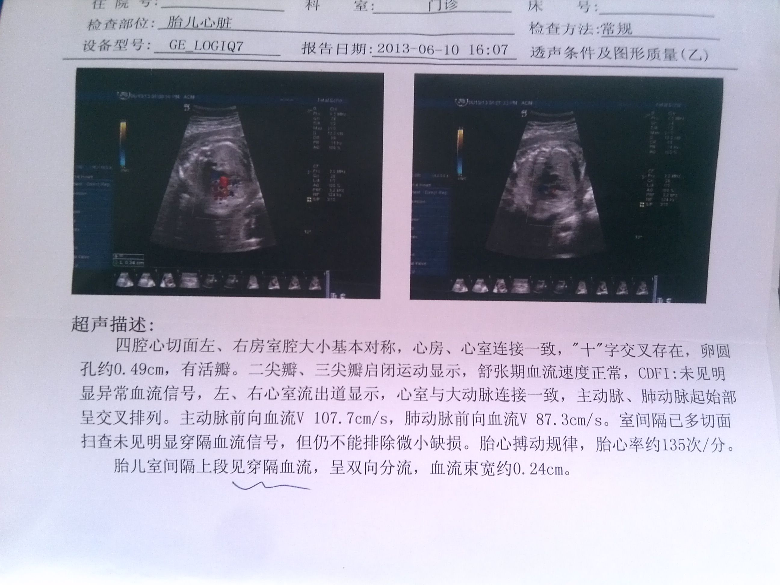 心脏外科完成首例急性心梗复合型心脏破裂手术-陕西省人民医院