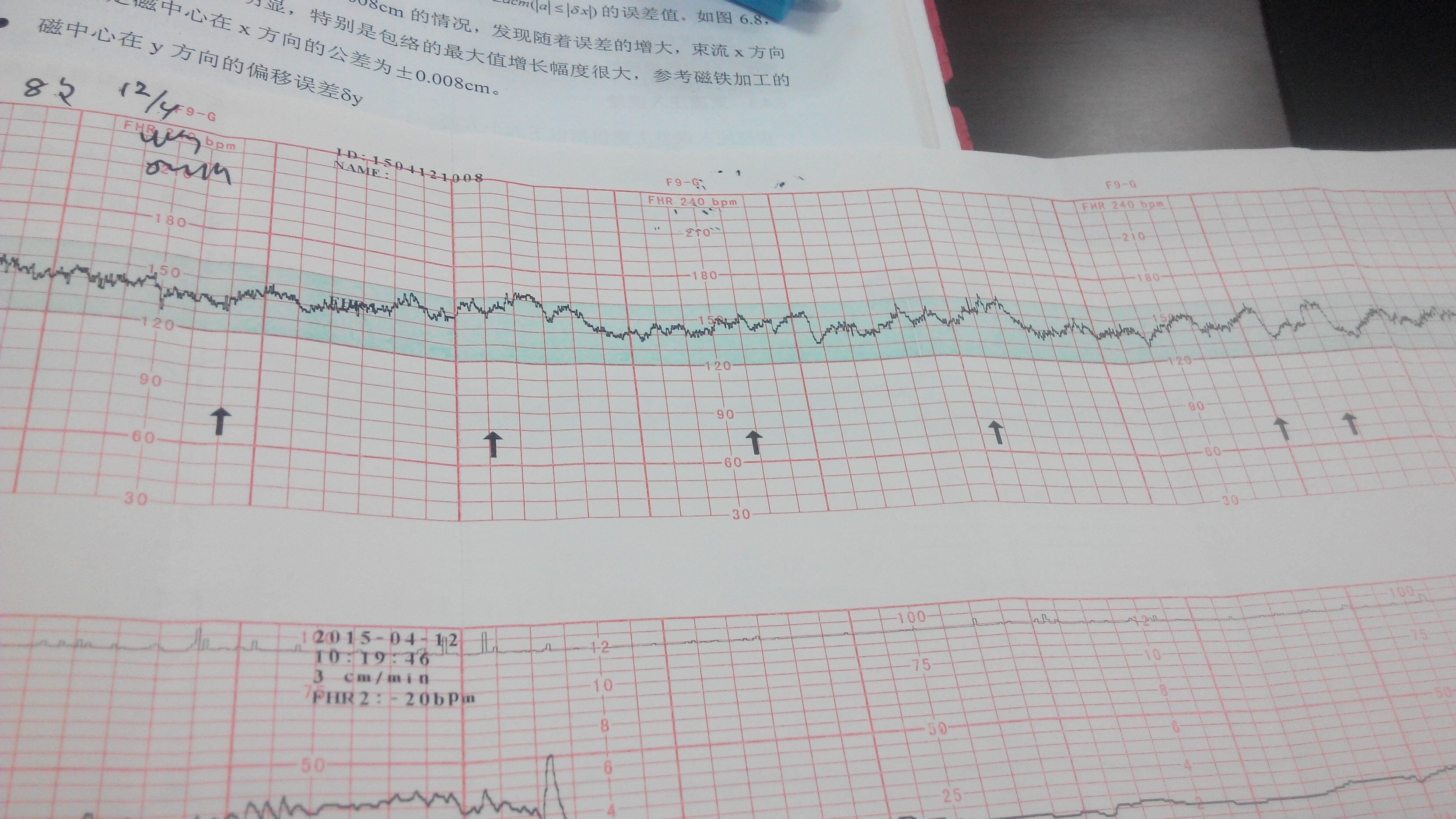 胎心监测曲线图怎么看?