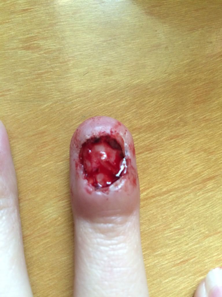 指甲受伤半个月了,指甲下面都是空的和淤血,今天好奇把指甲剪了,看着