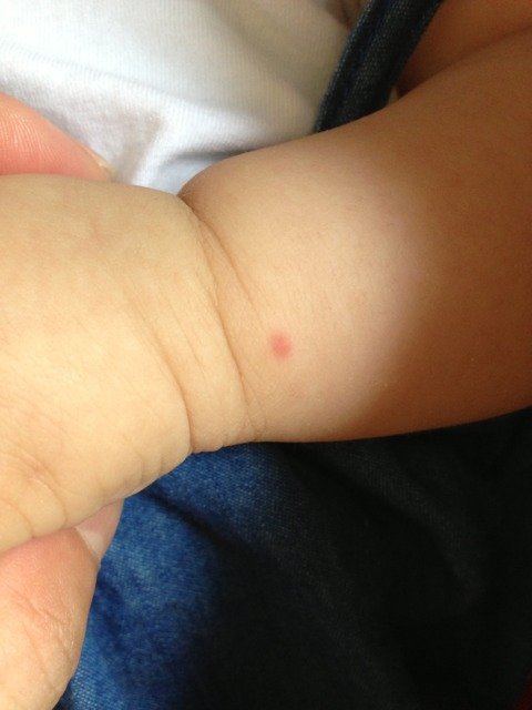 请问宝宝手上红点是怎么回事?