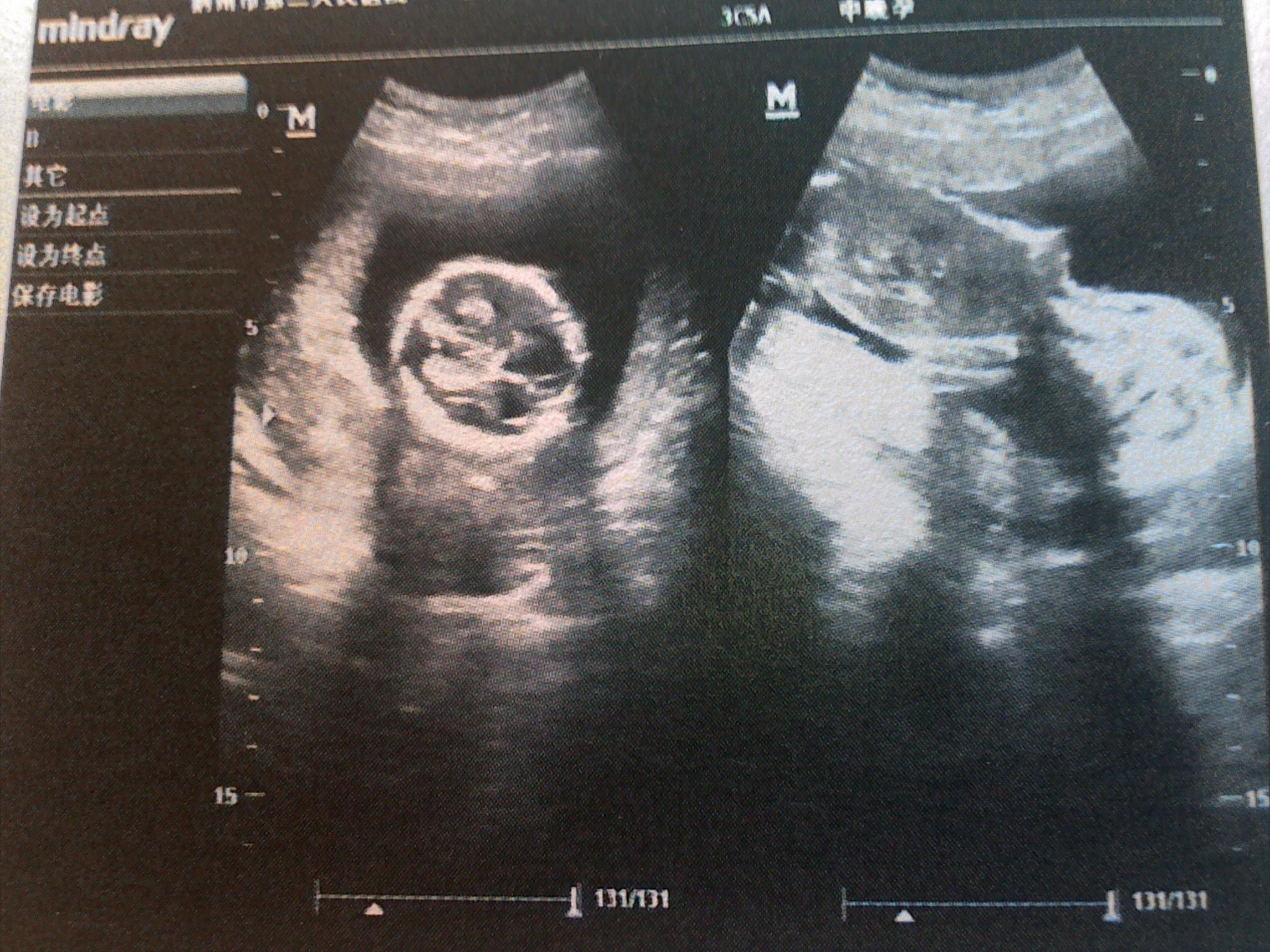 怀孕8个月时产检无胎心，医生一个办法让孕妈笑了