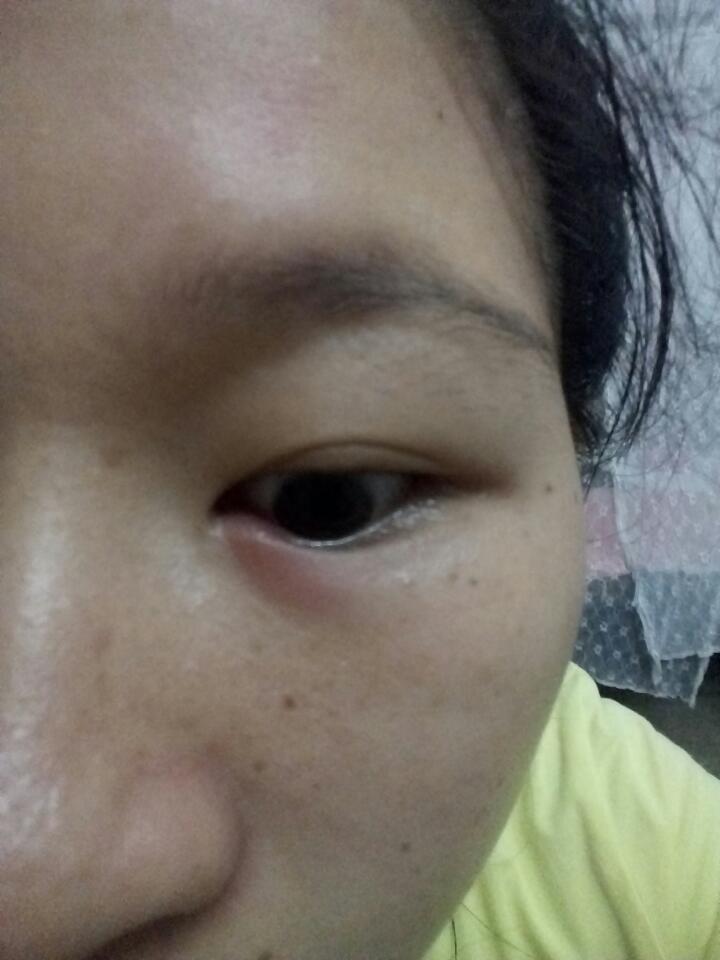 生完小孩半个月,昨晚开始眼睛有点肿痛,今晚就更严重了,有知道原因的
