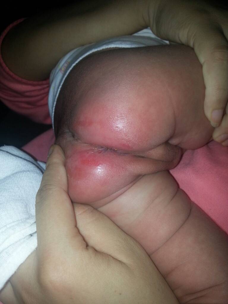 25天新生儿屁股红,肛门周围有红点(如图),宝宝哭闹,是怎么回事?