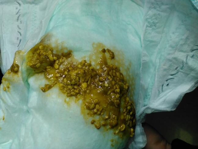 婴儿4o天大便有脓和血丝少的是之前的多的是现在的,打消炎针6天后是多