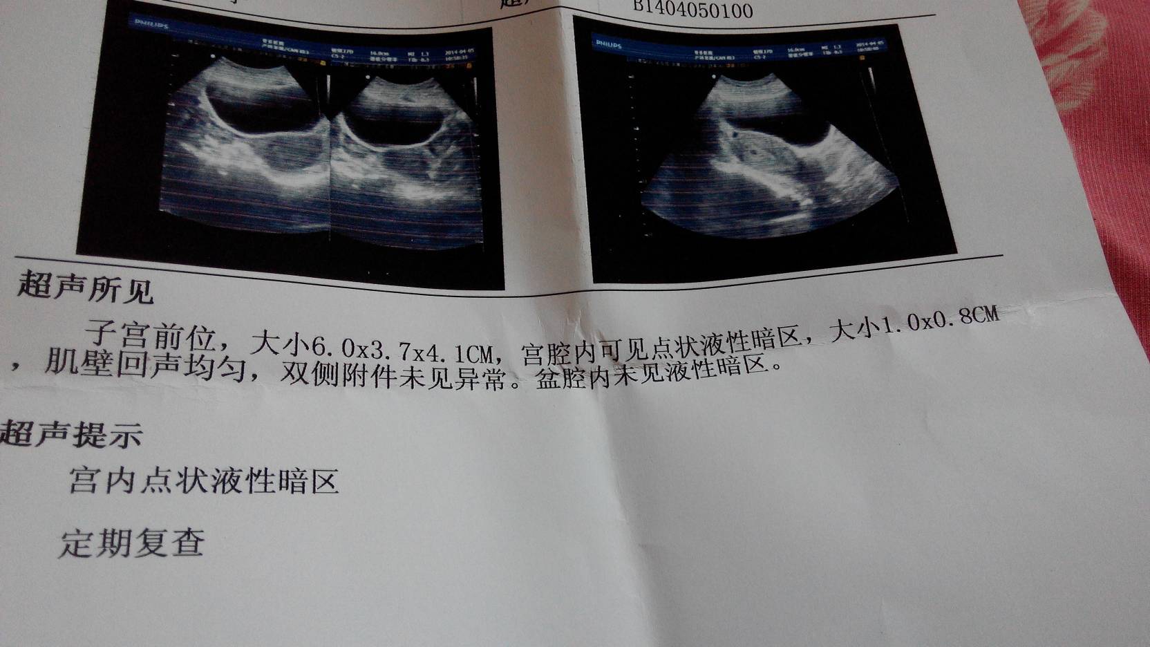 怀孕12周，发现子宫里面有6.7cm的积液，求助 - 知乎