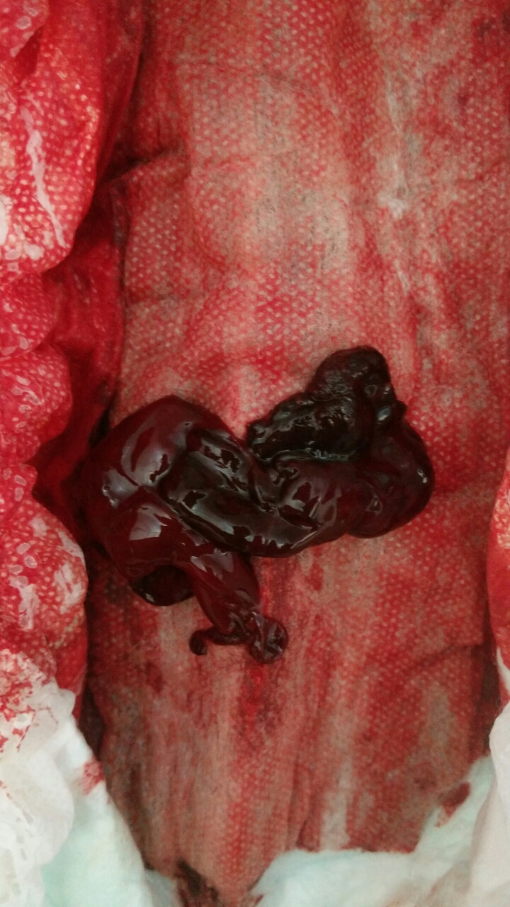 月经血鲜红图片