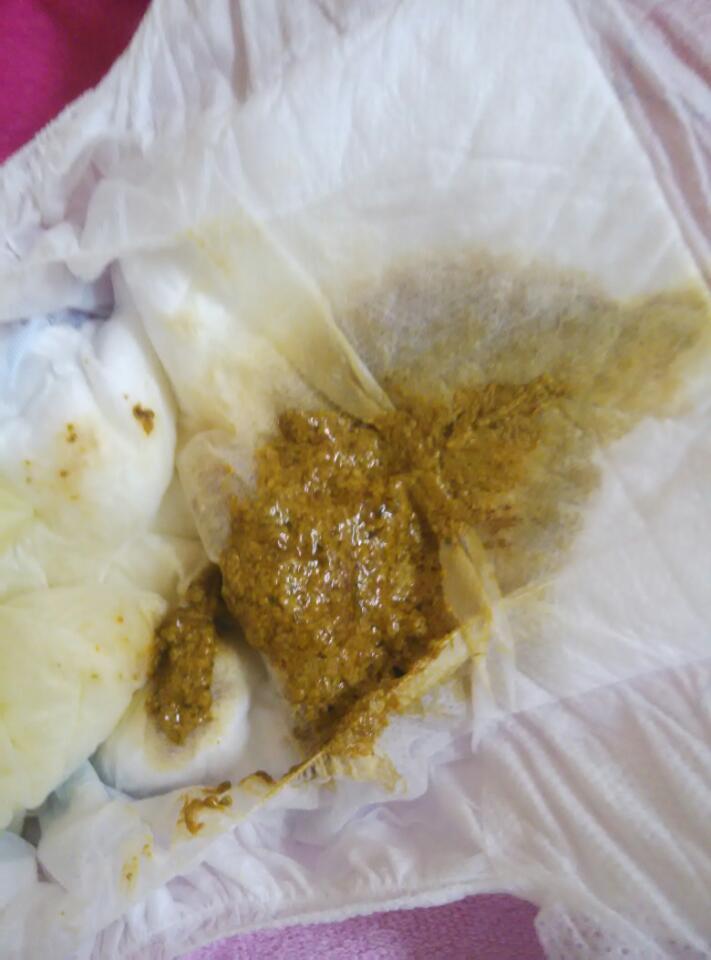 有医生在吗 新生儿的大便是这种颜色正常吗 之前是黄色的