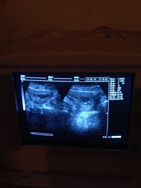 怀孕12周男孩孕囊图图片