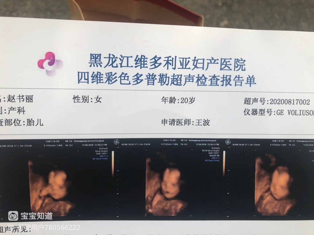 22周1四维彩超顺利通过,宝宝全程很配合