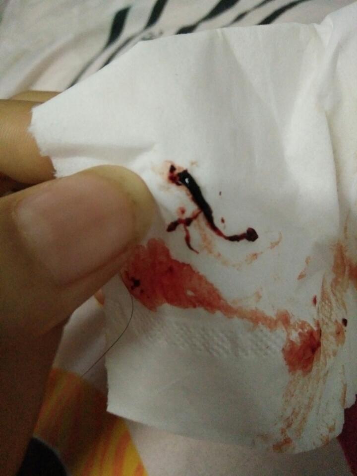 先兆流产出这样的血块 还保得住吗