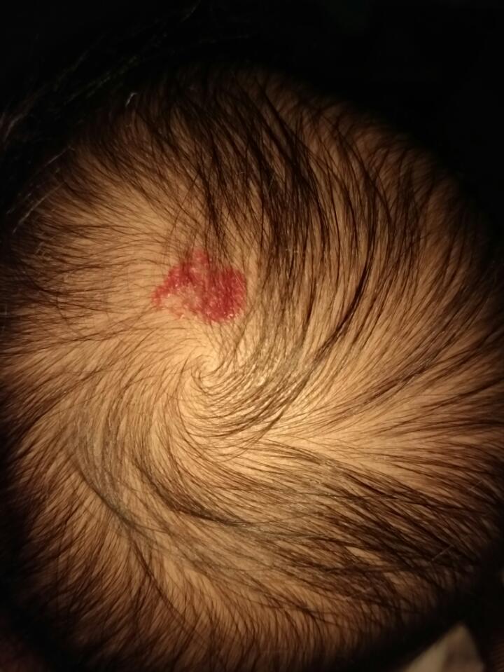 头顶血管瘤严重吗?