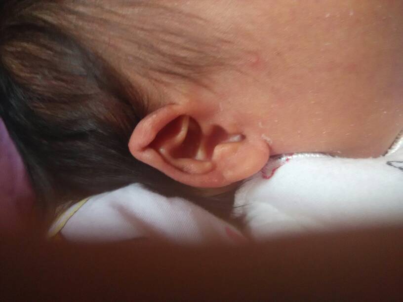 新生儿耳垂有折痕图片图片