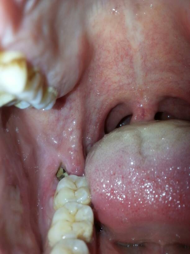 智齿拔掉后的第7天,请问照片上的情况正常吗?