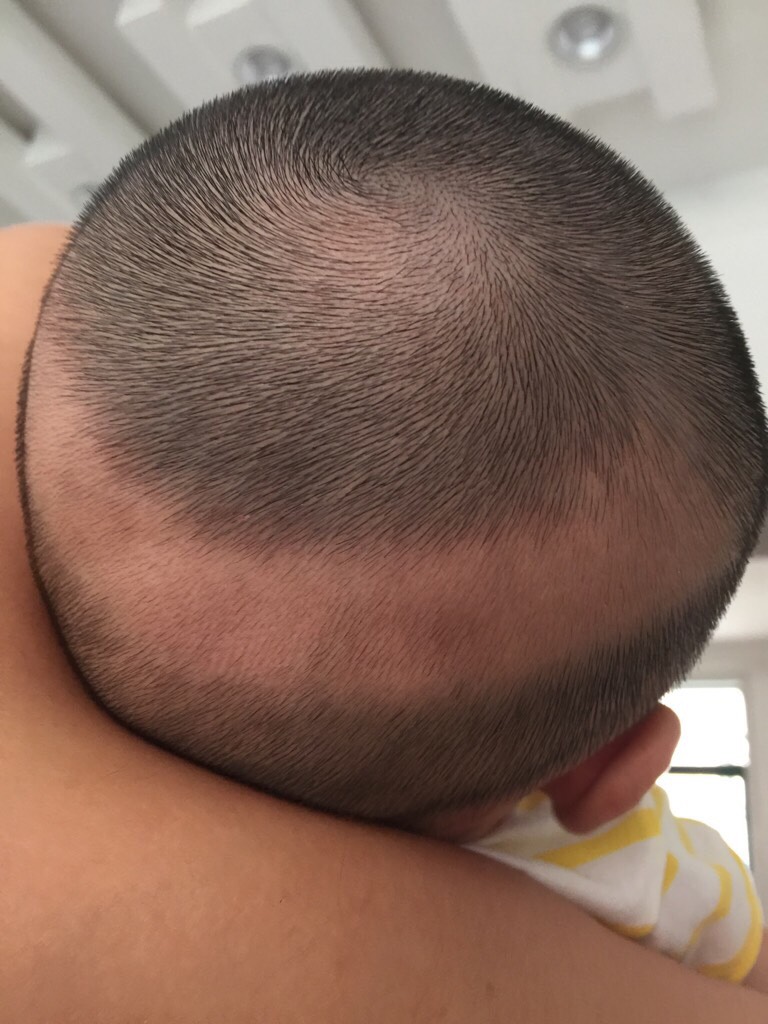 问答 新生儿宝宝的后脑勺像这个样子是怎么回事?