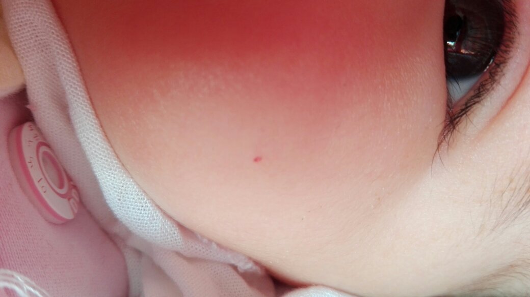 三个月宝宝脸上长个小红点,不知道是什么引起的,有影响吗