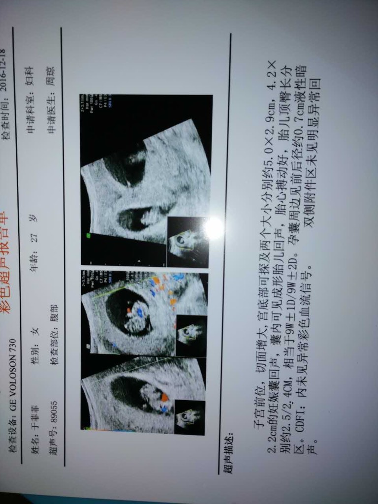 8周孕囊大小图片