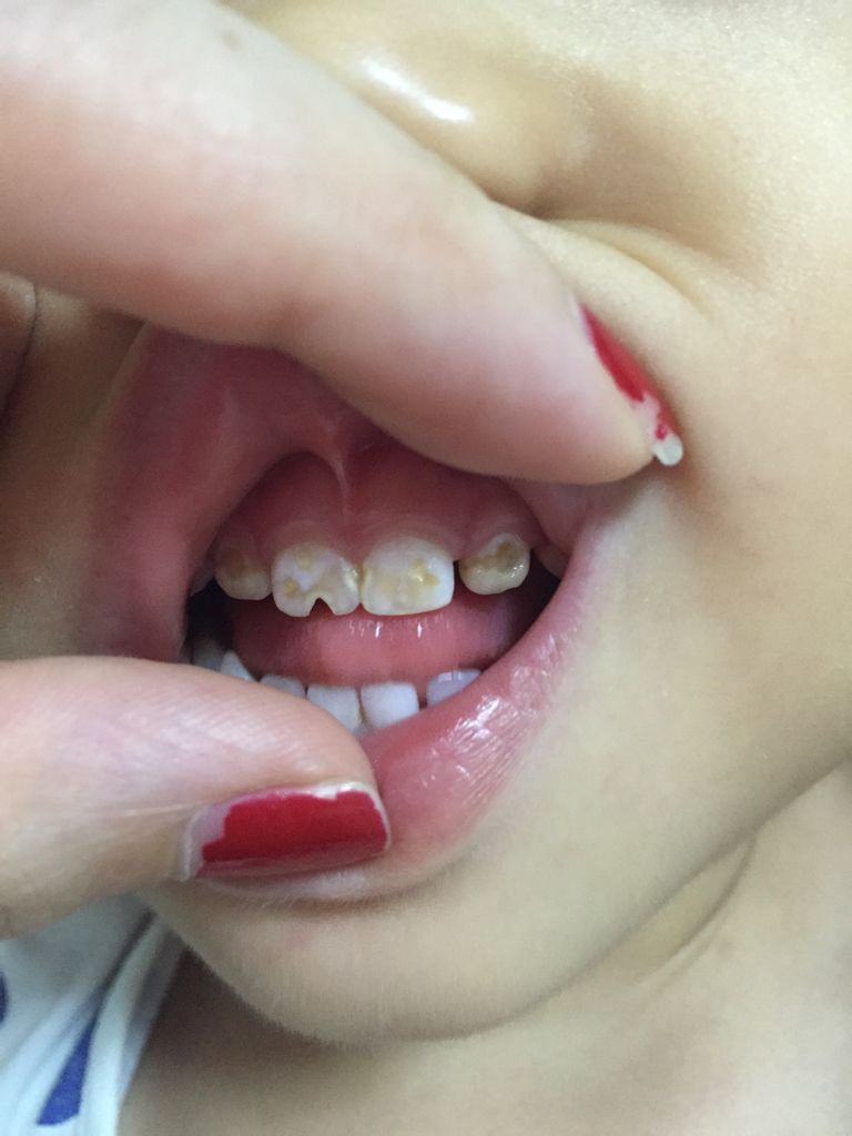 宝宝两岁四个月 她的牙齿这是怎么了,刚开始以为是烂了,每天都有刷牙