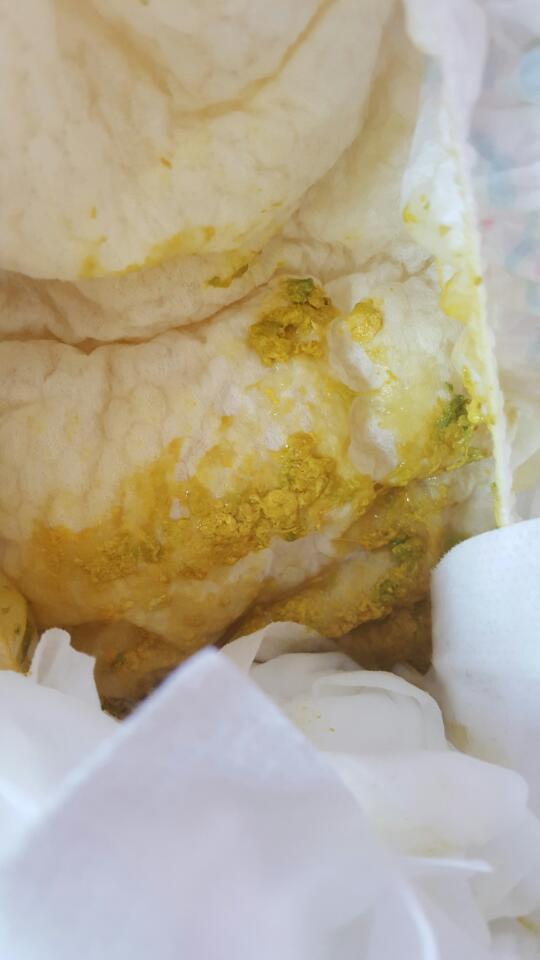 有粘液,大便里有绿点,经常吐奶,有的时候吐的有点多,肚脐周围有点硬