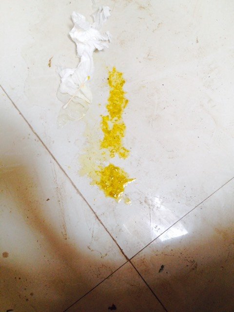 宝宝大便是这样的正常吗?有白白粘稠的东西,看像是没消化得